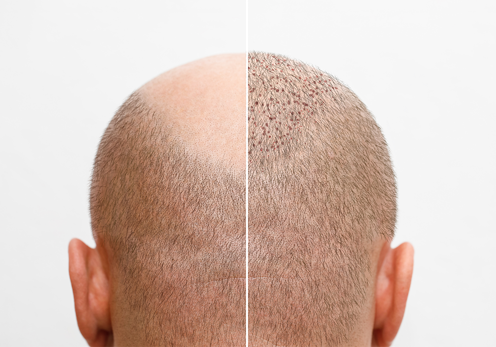 Hair Transplantation