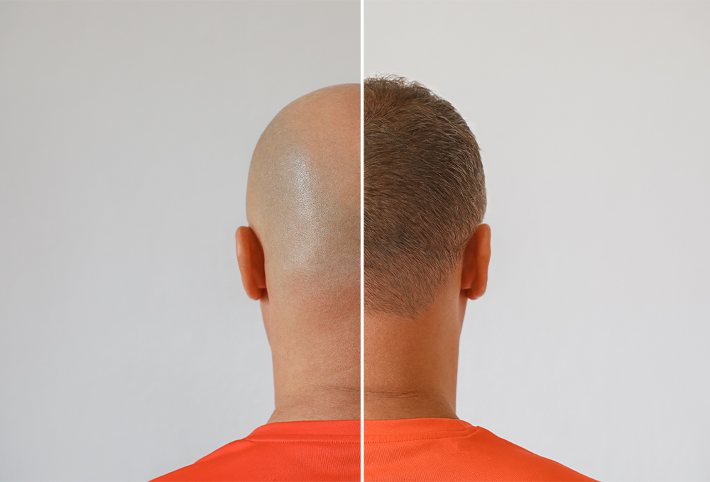 How to do Hair Transplantation?