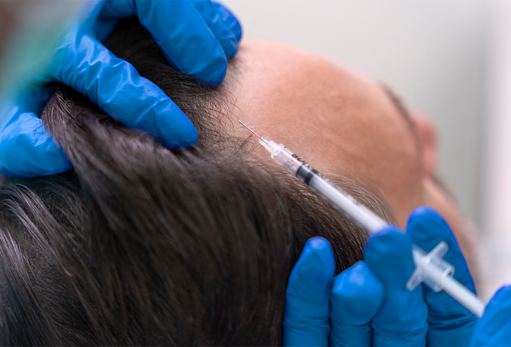 What is Hair Transplantation?
